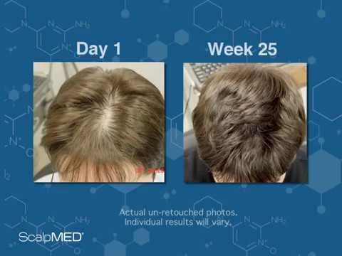 Scalp Med®: Incredible Customer Success Before & After Photos - YouTube