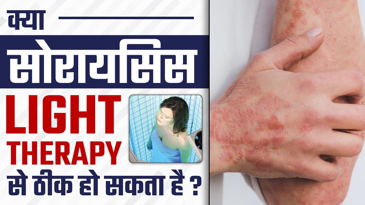 क्या सोरायसिस Light Therapy से ठीक हो सकता है ? Side Effects of Light