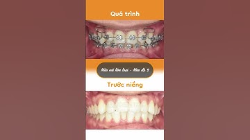 Hành trình LỘT XÁC nhờ niềng răng của Tấn Nhựt
