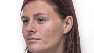 Acne Foundation- Full Coverage without the risk of more breakouts!