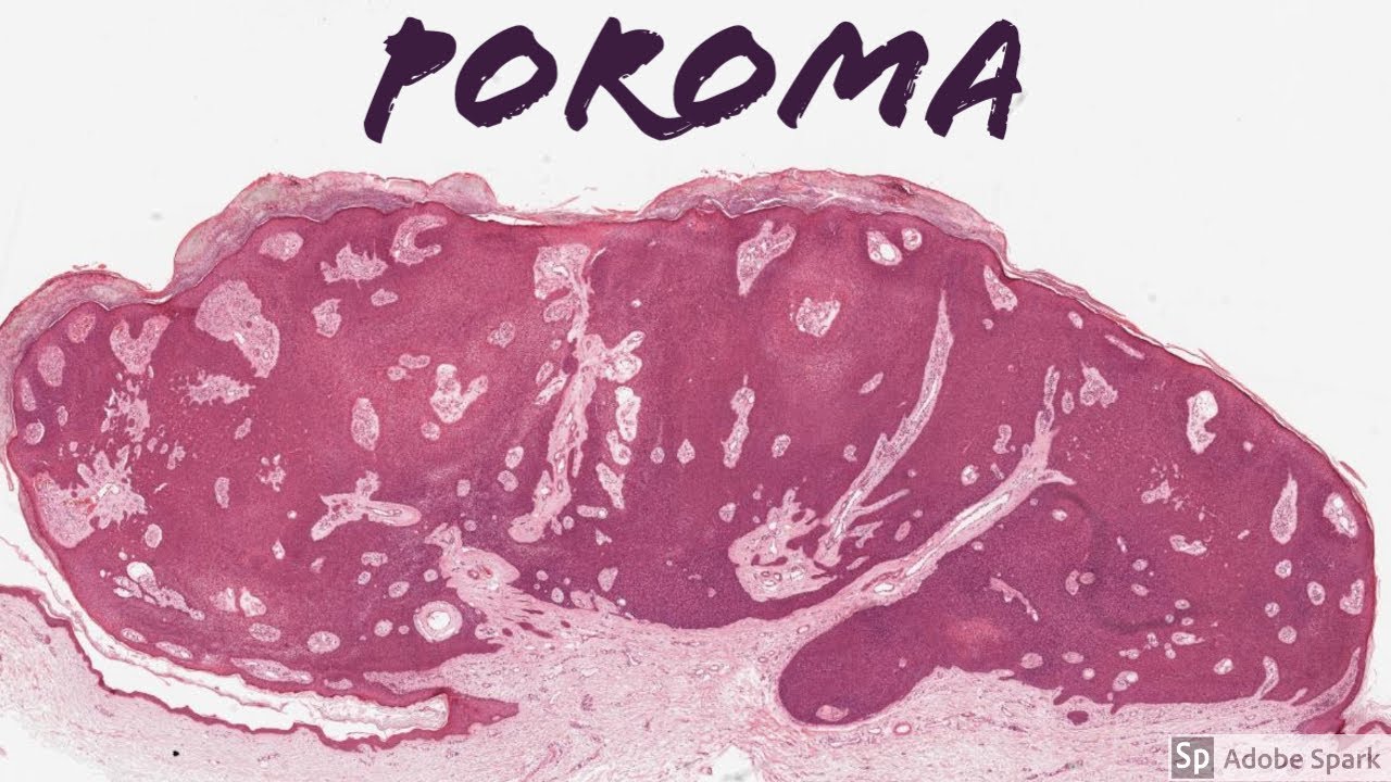 Poroma: 5-Minute Pathology Pearls
