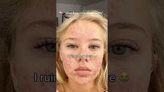 Celebrity This ONE ingredient fixed my skin when NOTHING else worked! 🤯 #beeftallow #skincare #acne #fyp Net Worth