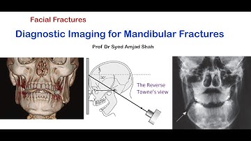 Diagnostic Imaging for Mandibular fracture | Oral & Maxillofacial Surgery | Syed Amjad Shah