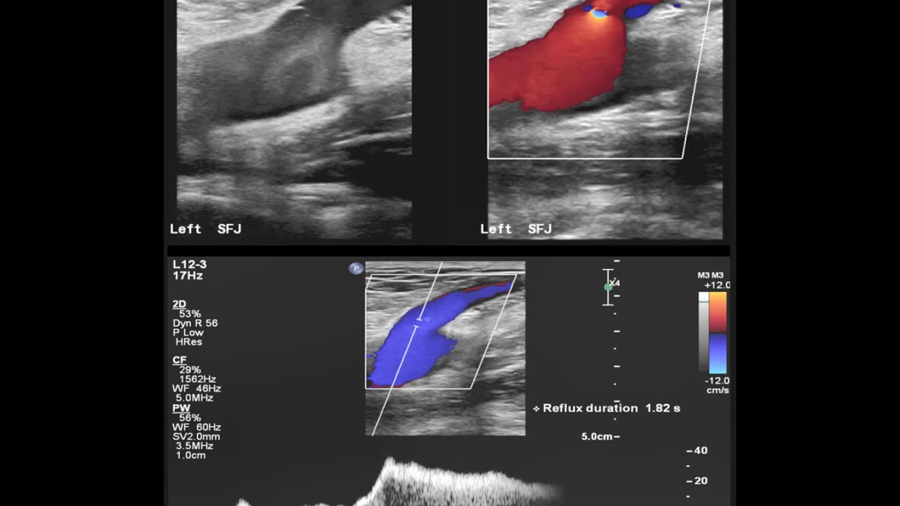 Saphenofemoral Junction Reflux In 3 Duplex Ultrasound Modes YouTube Saphenofemoral Junction Reflux In 3 Duplex Ultrasound Modes YouTube
