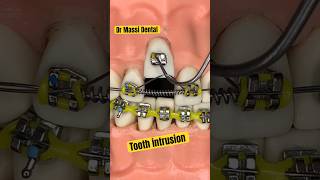 Tooth intrusion by Braces Brackets Orthodontic