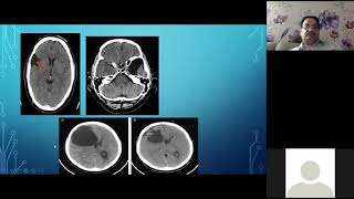 FJMU weekly Case presentation Arachnoid cyst.