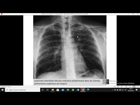 Vidéo: Modifications Du Parenchyme Des Organes - Causes De Modifications Diffuses, Symptômes, Diagnostic, Augmentation De L'échogénicité Du Parenchyme