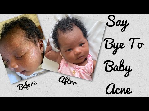 How to get rid of Baby Acne in 3 days