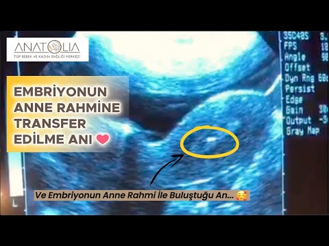 Embriyonun Anne Rahmine Transfer Anı | Embriyo Transferi