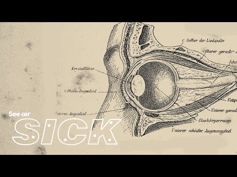 ग्लूकोमा कैसे दृष्टि हानि का कारण बनता है?