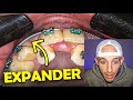 Palatal expanders for adults with bracesorthodontist explains marpe