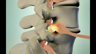 Lumbar disc herniation