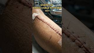 How Do Dissolvable Stitches Disappear Inside Your Body? 🧵🤯(3d Animation)