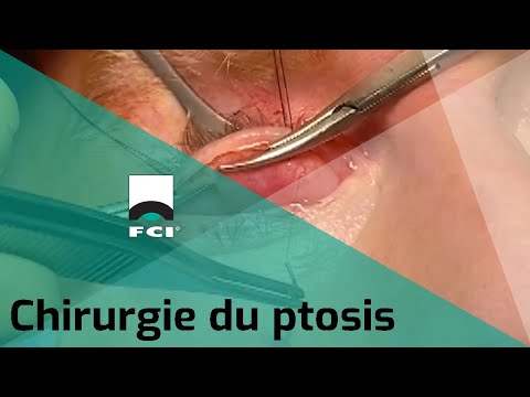 Vignette Vidéo | Technique Fasanella-Servat dans la chirurgie du ptosis