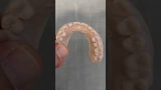 Orthodontic treatment to fix an impacted tooth with braces and aligners  #braces #invisalign #shorts
