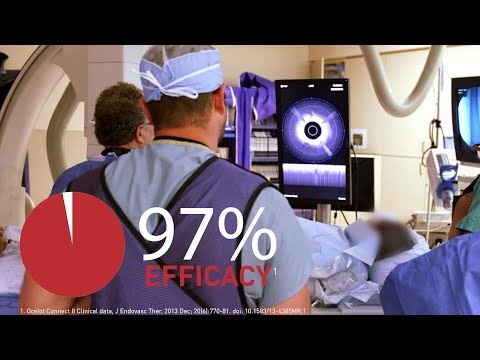 Ocelot OCT-Guided Crossing for Chronic Total Occlusions - Testimonial and Data - video from Avinger