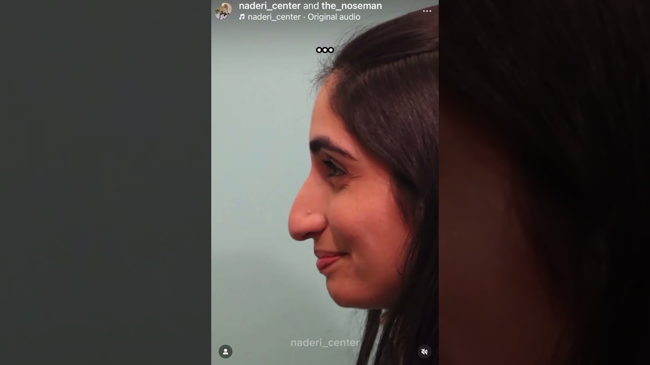 Rhinoplasty patient of Dr. Shervin Naderi, before and after video