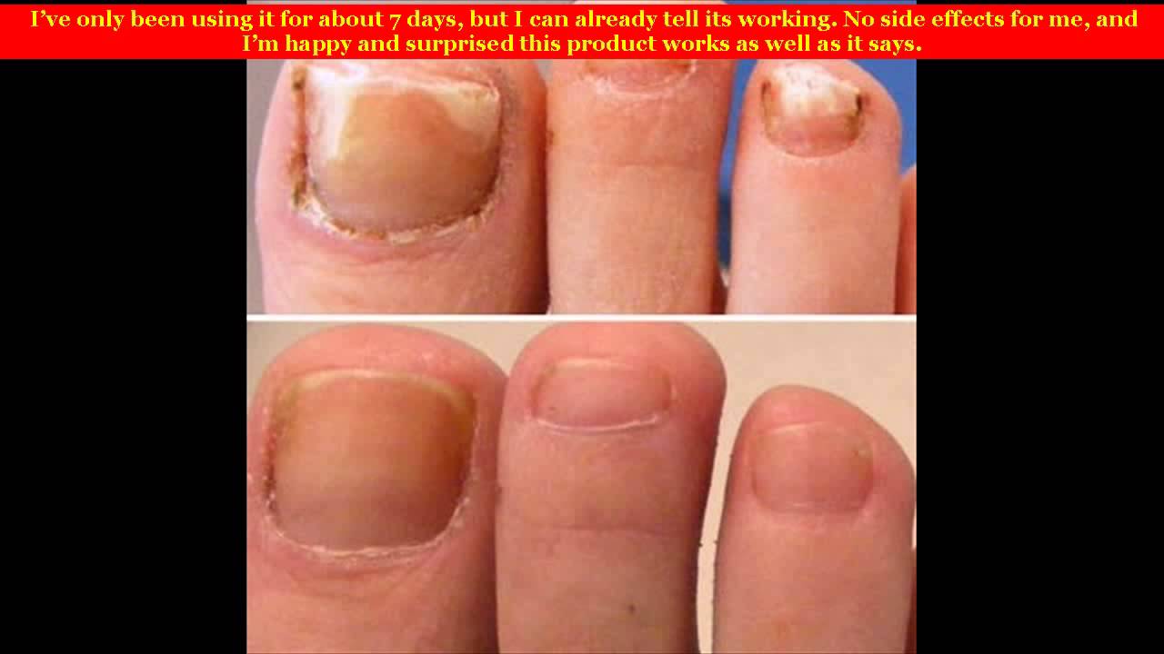 Fungal Nail Infection Treatment Reviews YouTube