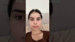 got all 4 wisdom teeth removed and became a chipmunk