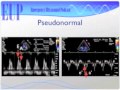 Ultrasound Podcast - DIASTOLOGY ULTRASOUND - PART 2