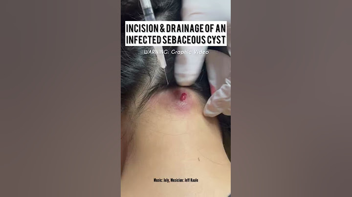 Incision and Drainage of a Sebaceous vs Epidermoid Cyst #shorts