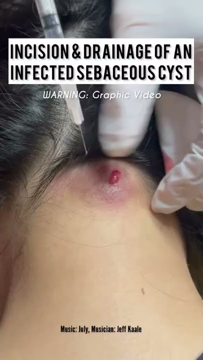 Incision and Drainage of a Sebaceous vs Epidermoid Cyst #shorts