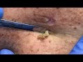 Biggest Blackheads and Large Cysts!  Contour Dermatology is King!