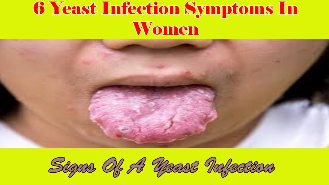 6 Yeast Infection Symptoms In Women Signs Of A Yeast Infection Youtube