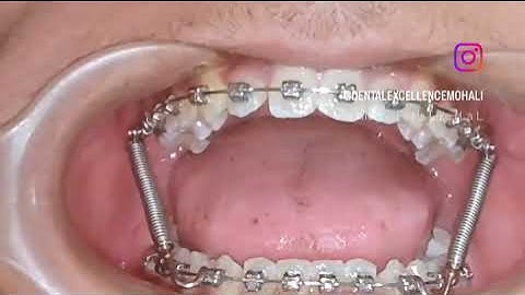 Forsus: Fixed Functional Appliance