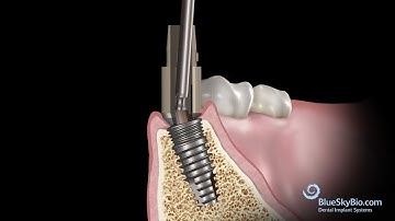 Restoration with a Rosetta Universal Scan Body Component