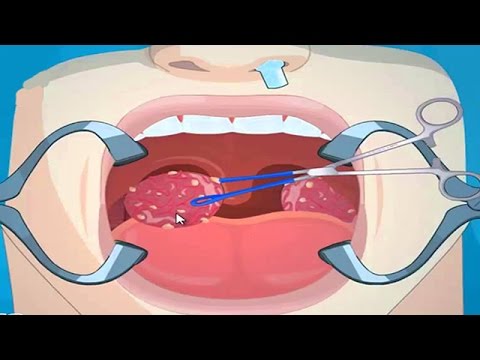 Tonsil Removal Surgery Tonsillectomy