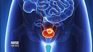 PROSTRATE CANCER AND ITS RISK FACTOR - ARISE NEWS REPORT
