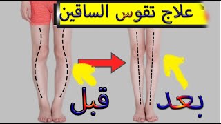 تمارين لعلاج تقوس الساقين في 15يوم  . Treatment of internal curvature of the knee