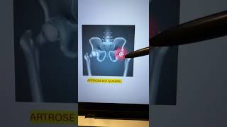 Dor na região anterior da coxa pode ser artrose no quadril ou dor no nervo femoral