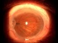 Vido n 7 du centre du glaucome  correctopie cataracte pupilloplastie dr ezzouhairi