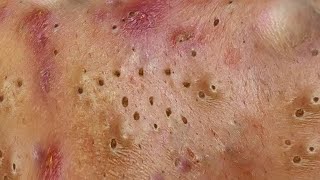 VD10 treatment acnes and blackheads acnetreatment blackheads dailyvlog