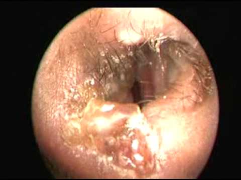 Video: Nasal Vestibulitis: Symptomer Og Foto, Behandling Og Komplikation