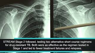 25 at 25: Shortening treatment for tuberculosis