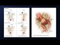 Pterional craniotomy for clipping of a ruptured incompletely coiled mca aneurysm