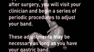 Lap Band Surgery - Laparoscopic Gastric Banding - Animation - Bariatric Weight Loss Solutions