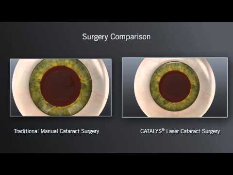 Laser Assisted Cataract Surgery - YouTube