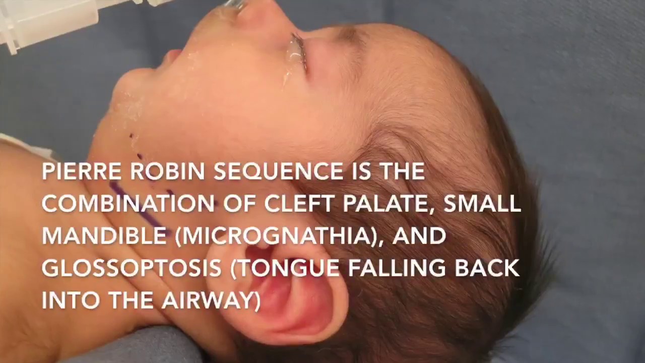 collagenopathy with pierre robin sequence collagenopathy with pierre robin sequence