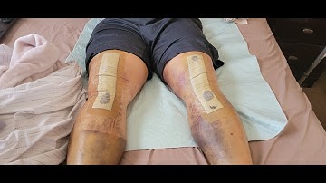 The Truth, Total Knee Replacement Bilateral 12 days Post Operation TKR Sports Recovery Pain DR Lies