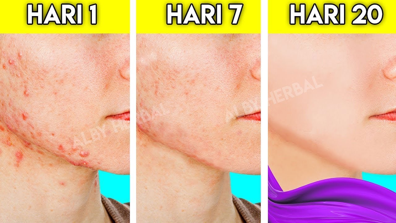 Cara Ampuh Menghilangkan Jerawat - YouTube