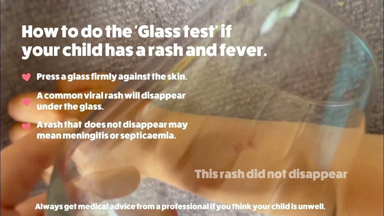 How to do the 'glass' test for meningitis. YouTube