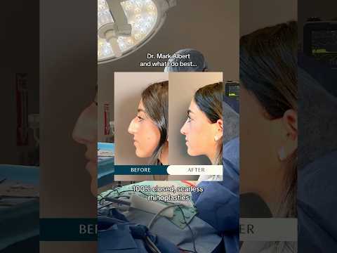 Video thumbnail: My expertise 🪄 #rhinoplasty #facelift · Albert Plastic Surgery New York