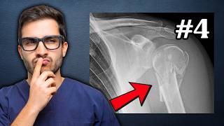 Top 5 Most Common Bone Fractures! (RANKED)