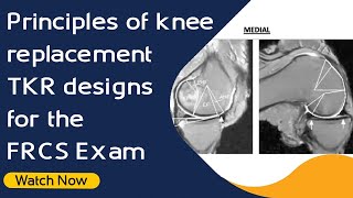 Principles of knee replacement TKR designs for the FRCS Exam