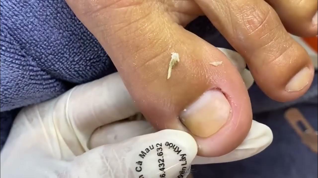 Ingrown Toenail Removal Toenail Cutting Xuyen Ca Mau 113 YouTube