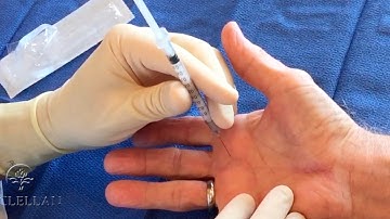 How to Perform a Trigger Finger (A1 Pulley) Injection.